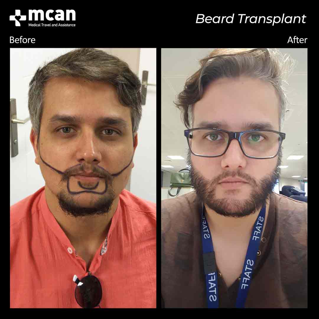hair transplant turkey before after 150321019