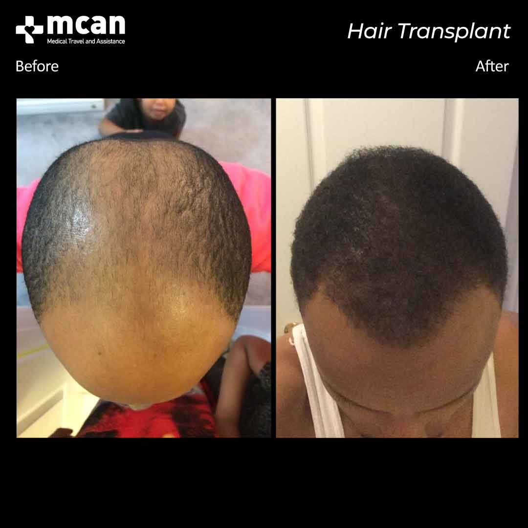 hair transplant turkey before after 15032102