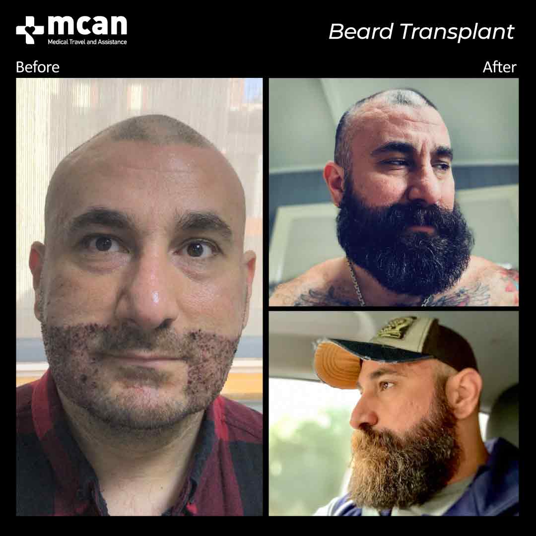 hair transplant turkey before after 150321020