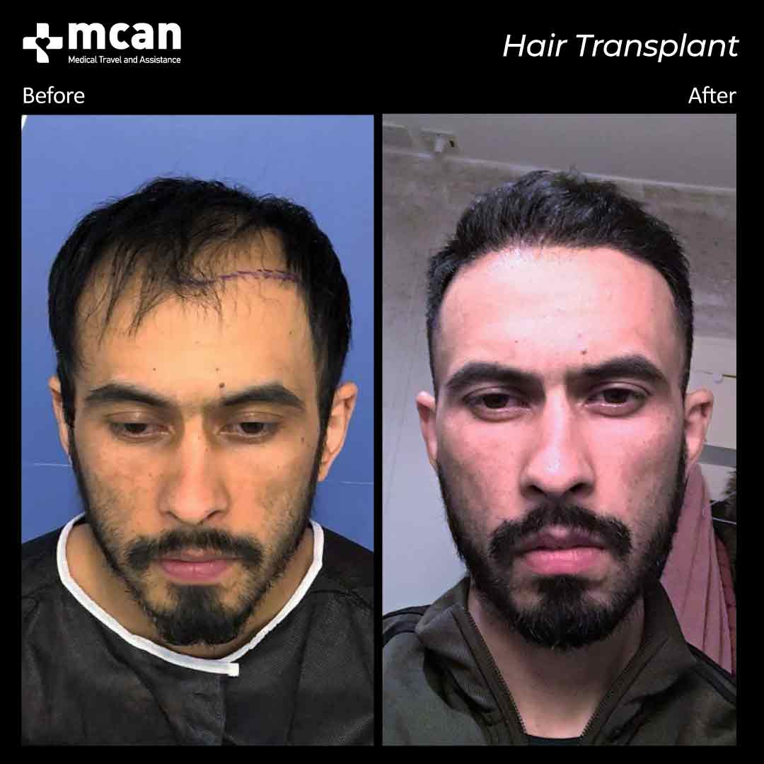 hair transplant turkey before after 150321022
