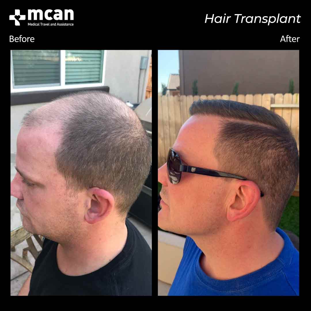 hair transplant turkey before after 150321023