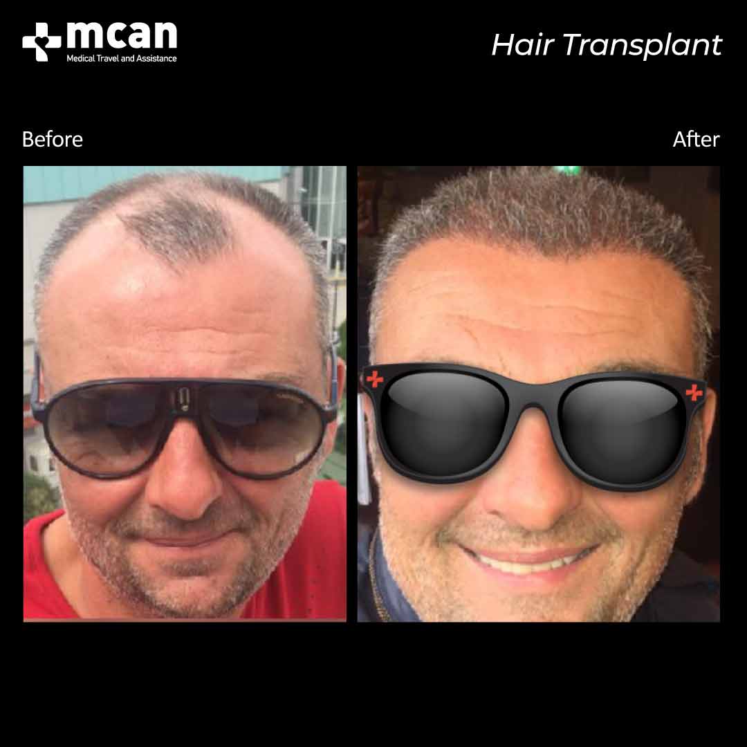 hair transplant turkey before after 150321025