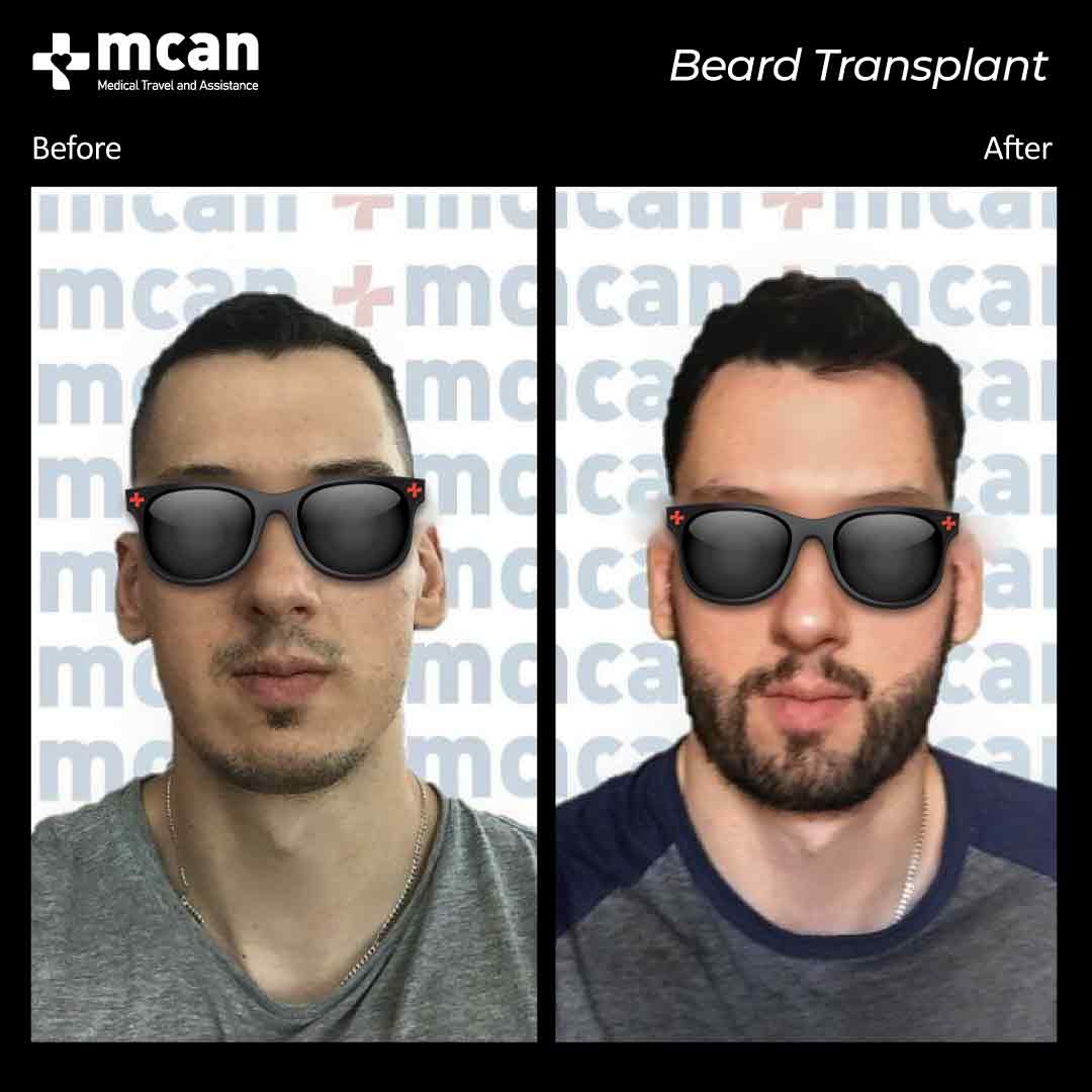 hair transplant turkey before after 150321026
