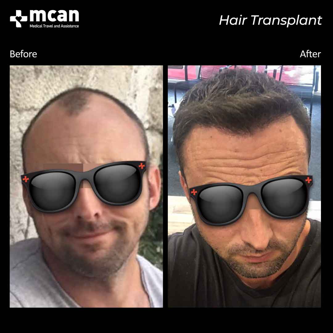 hair transplant turkey before after 150321027