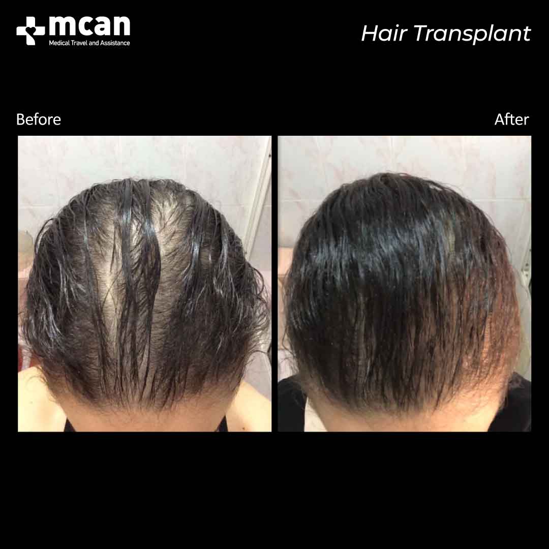 hair transplant turkey before after 150321028