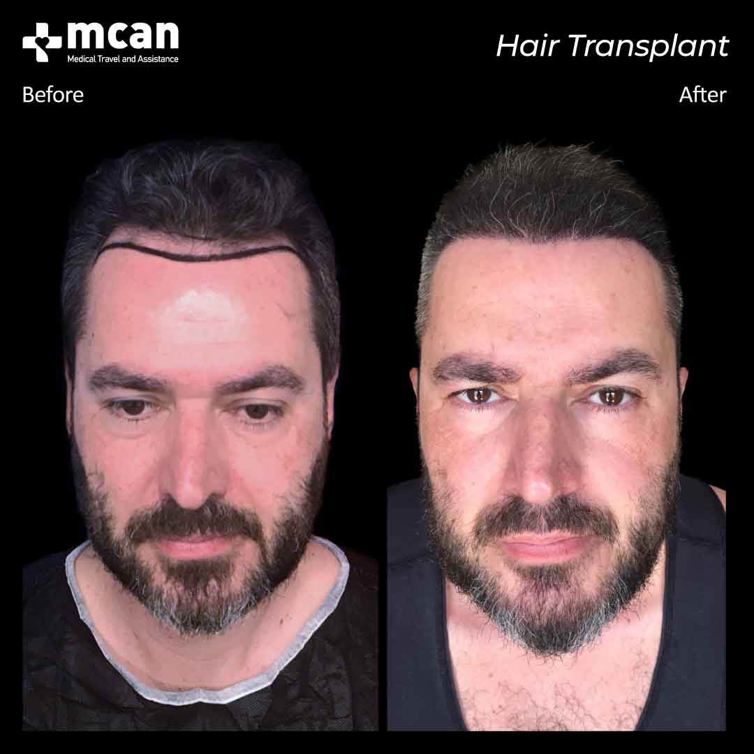 hair transplant turkey before after 150321029