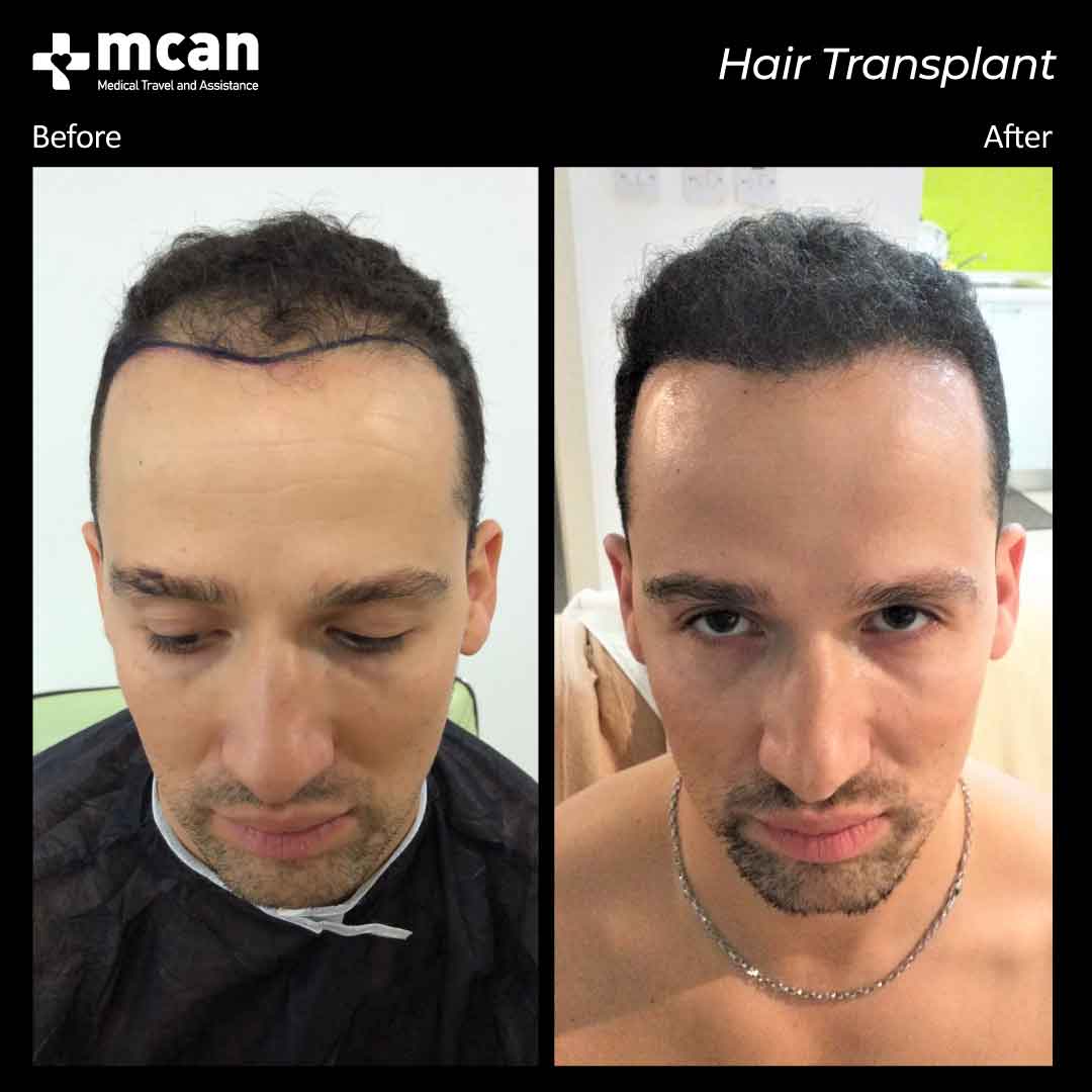 hair transplant turkey before after 15032103