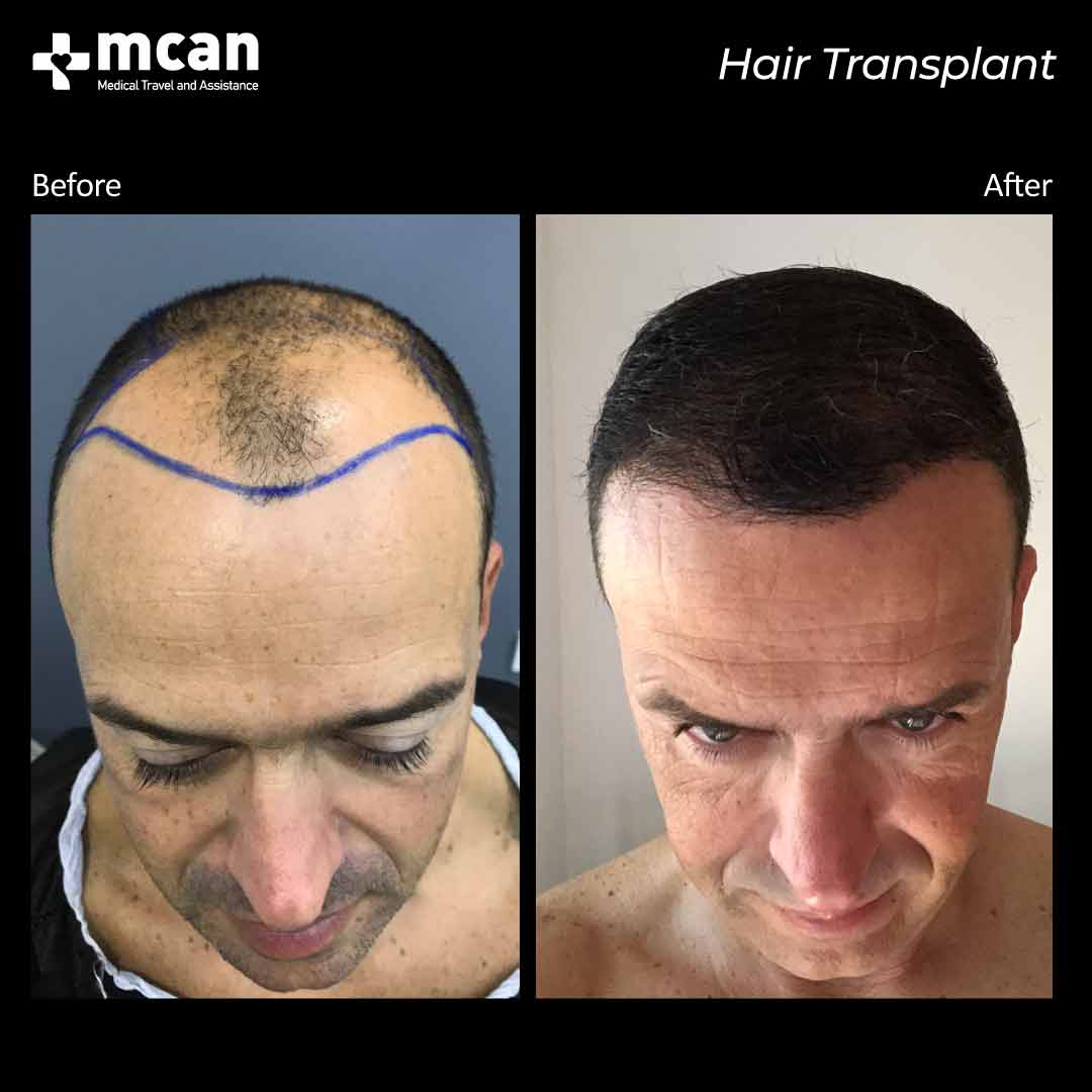 hair transplant turkey before after 15032104