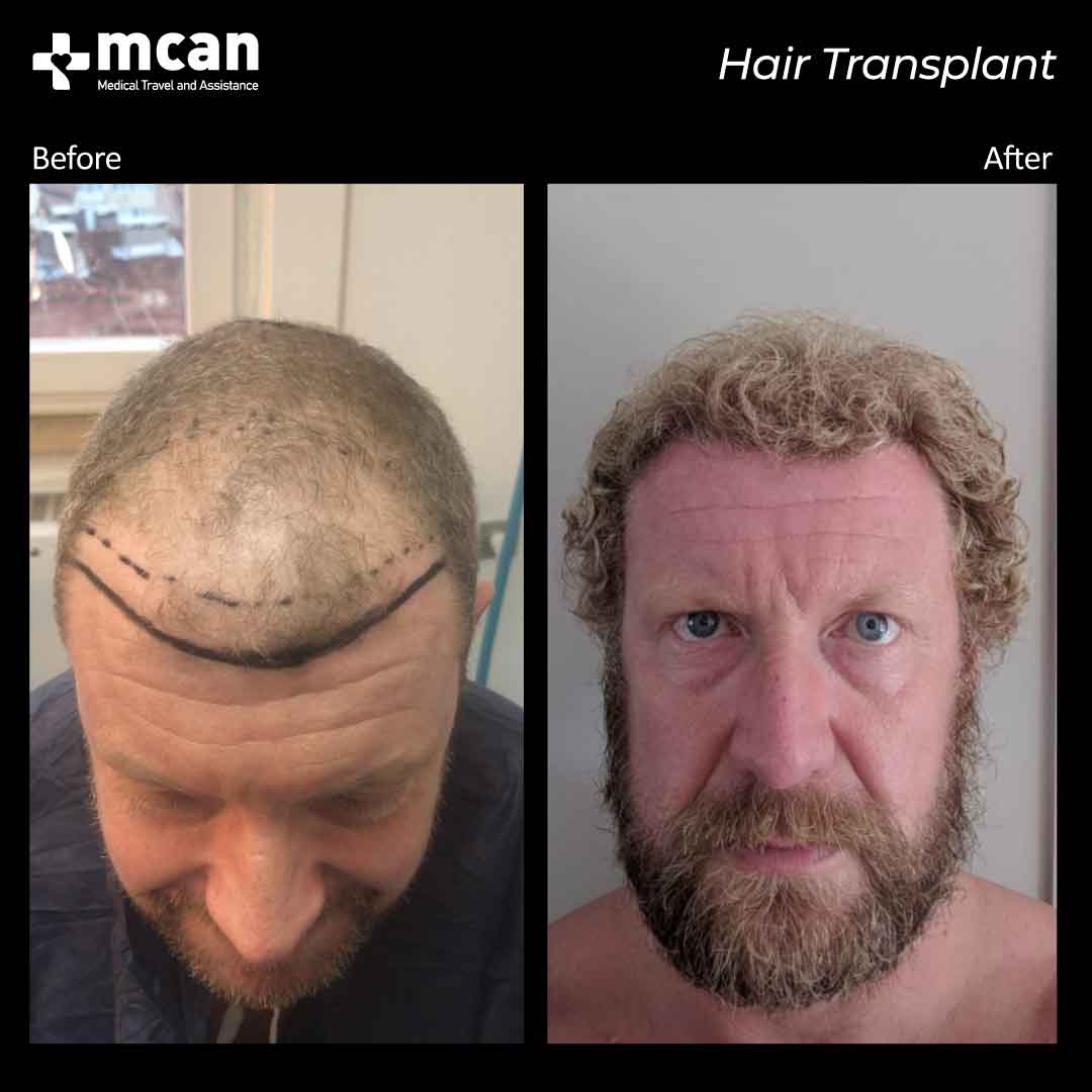 hair transplant turkey before after 15032105