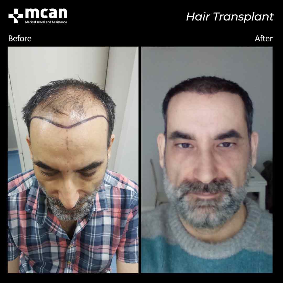 hair transplant turkey before after 15032106
