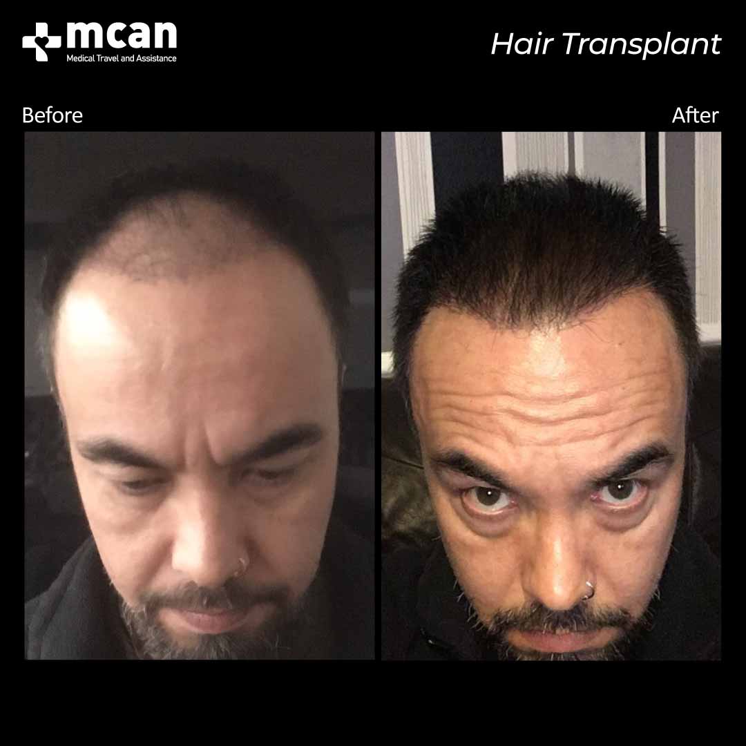 hair transplant turkey before after 15032107