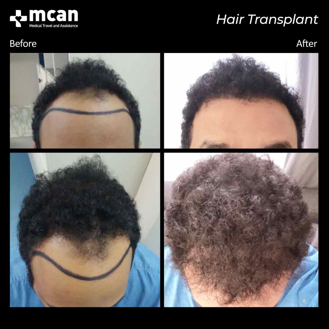 hair transplant turkey before after 15032109