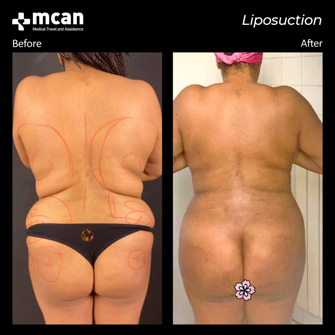 liposuction turkey before after 31032101