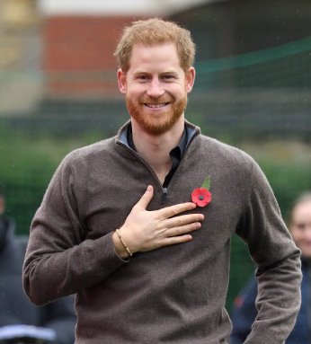 Prince Harry Interview and His Hair Transplant | Hair Transplant