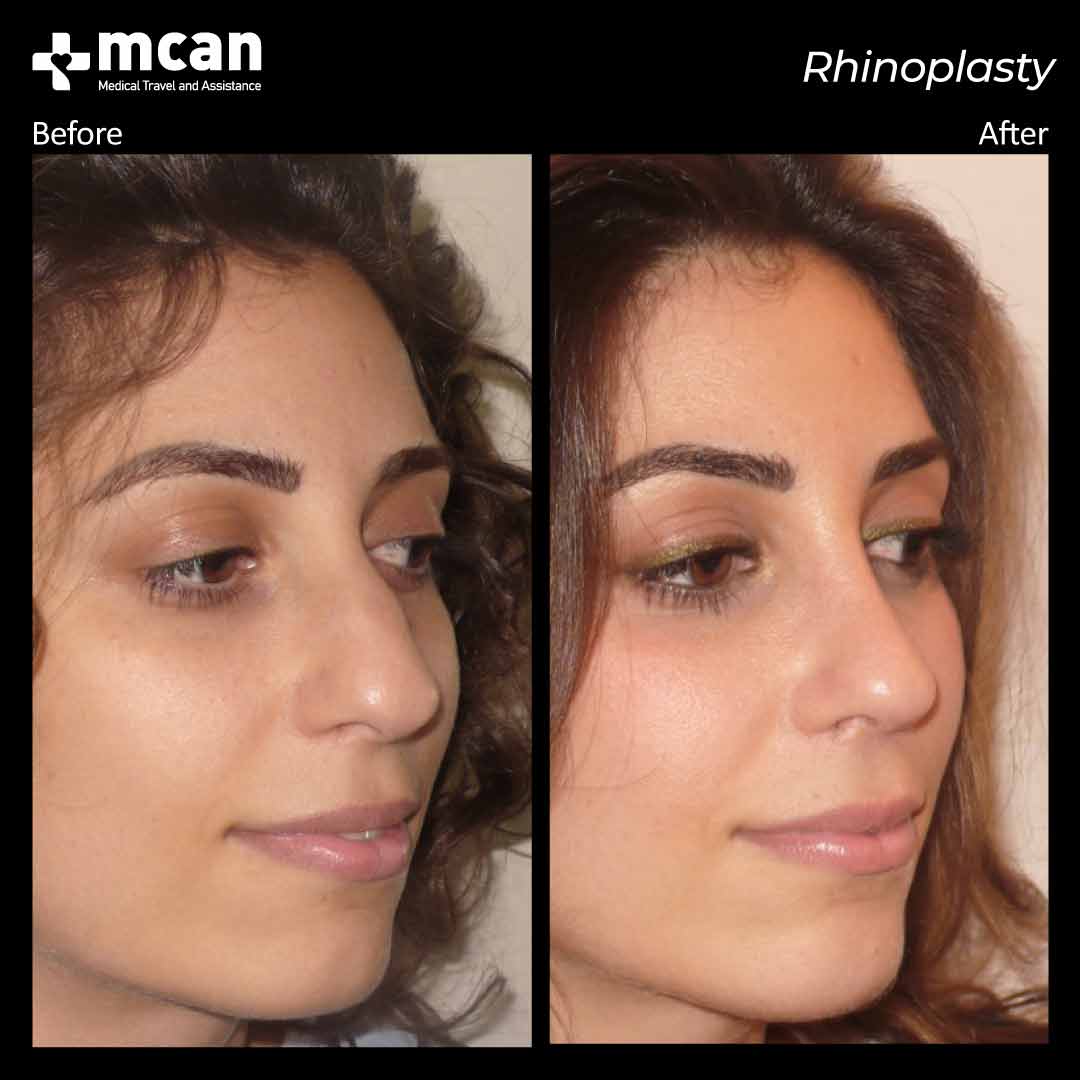 rhinoplasty before after 2203010 2