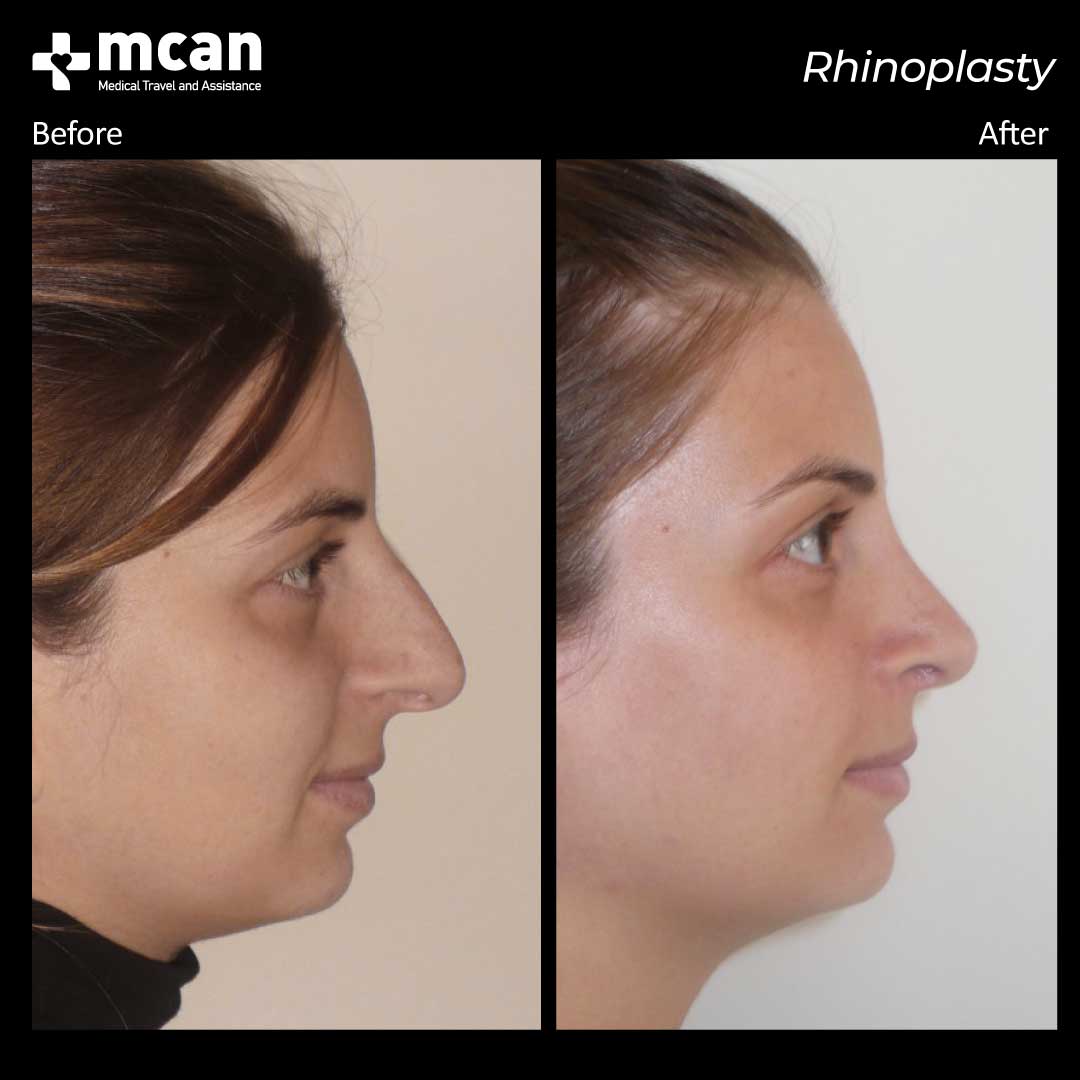 rhinoplasty before after 2203011 2