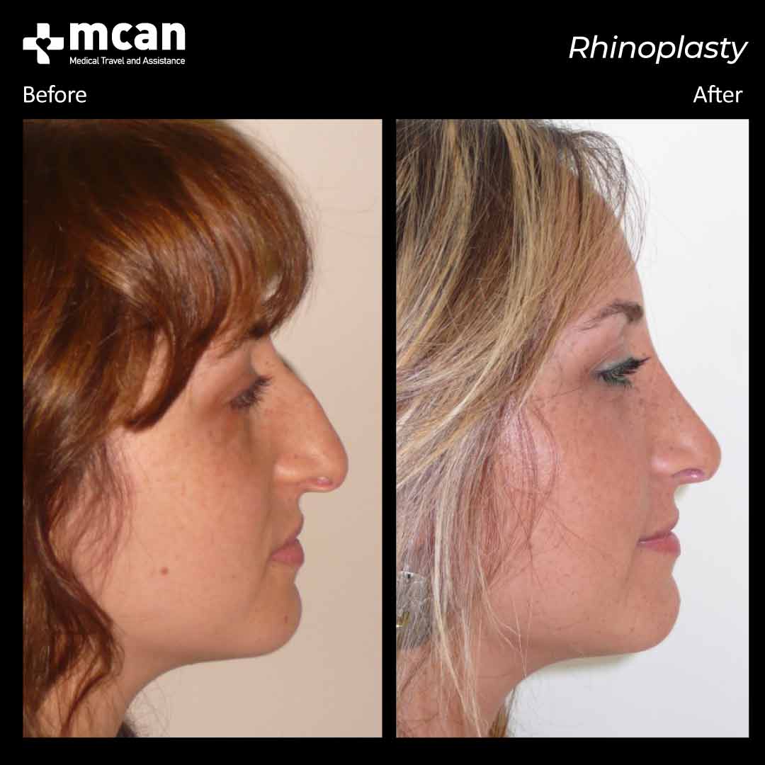 rhinoplasty before after 2203012 2