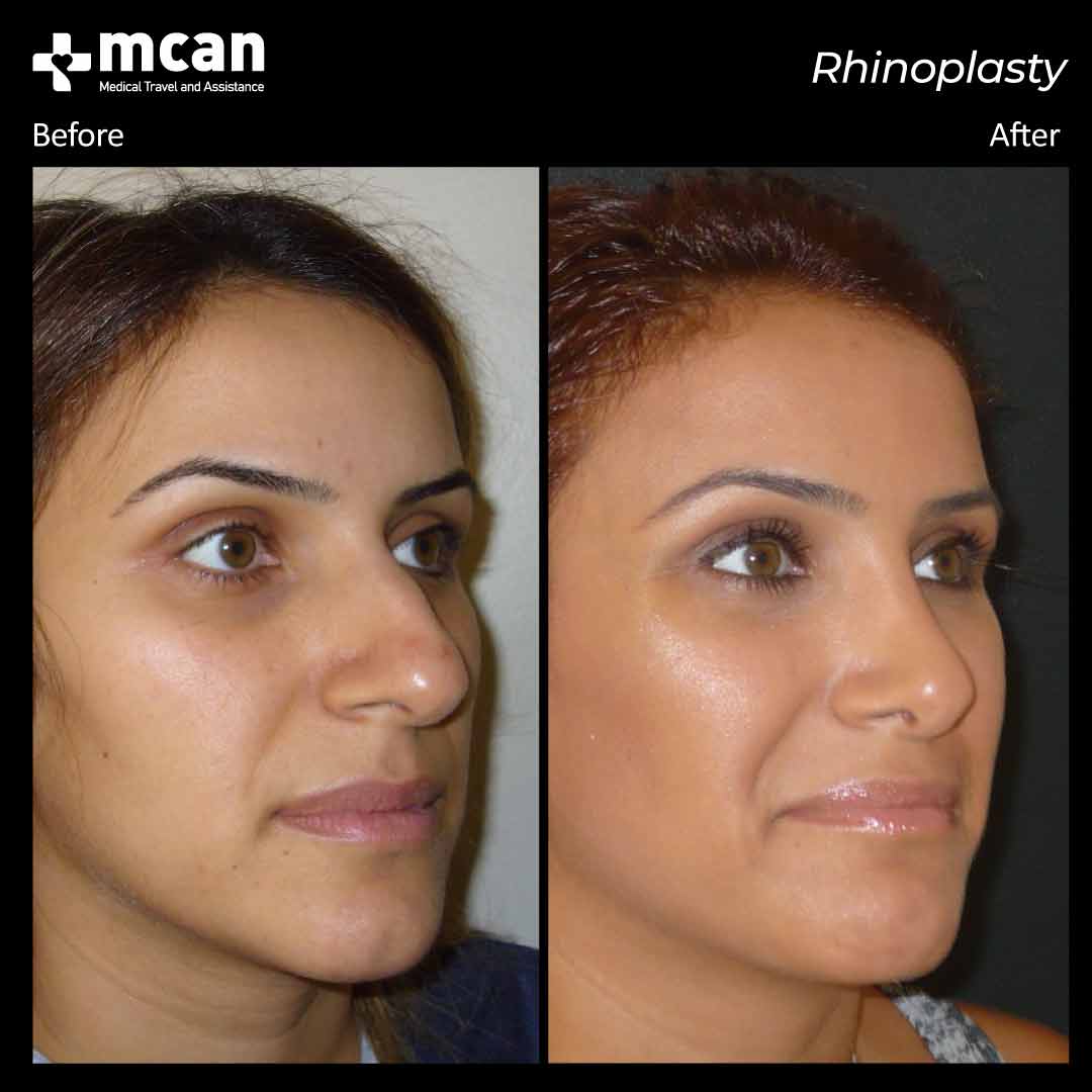 rhinoplasty before after 2203013 2