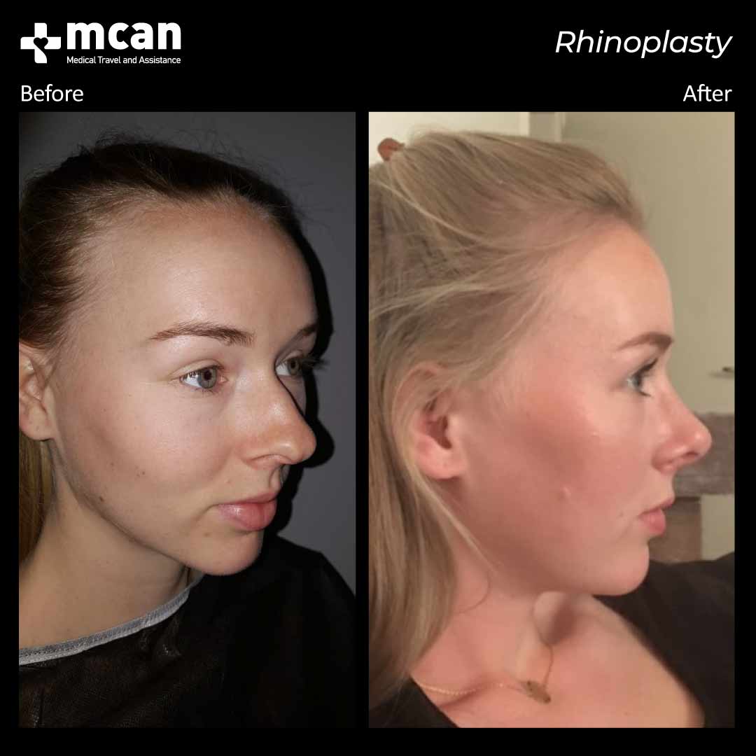 rhinoplasty before after 2203015 2