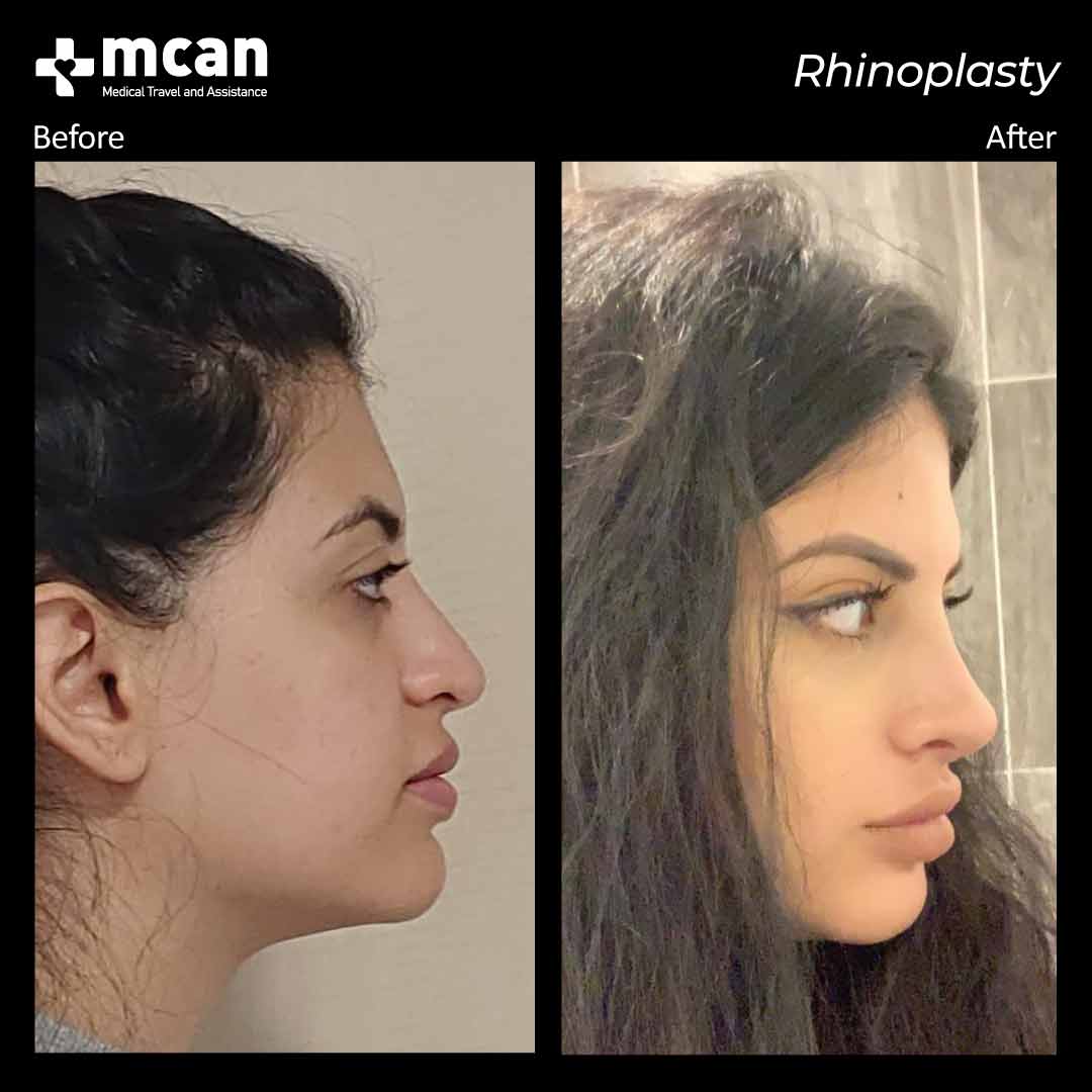 rhinoplasty before after 2203017 2