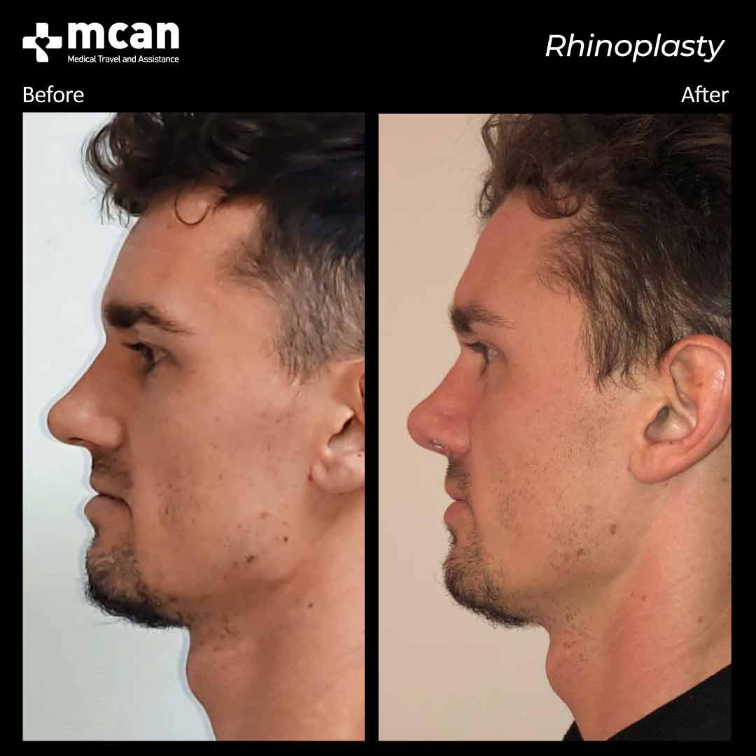 rhinoplasty before after 2203018 2