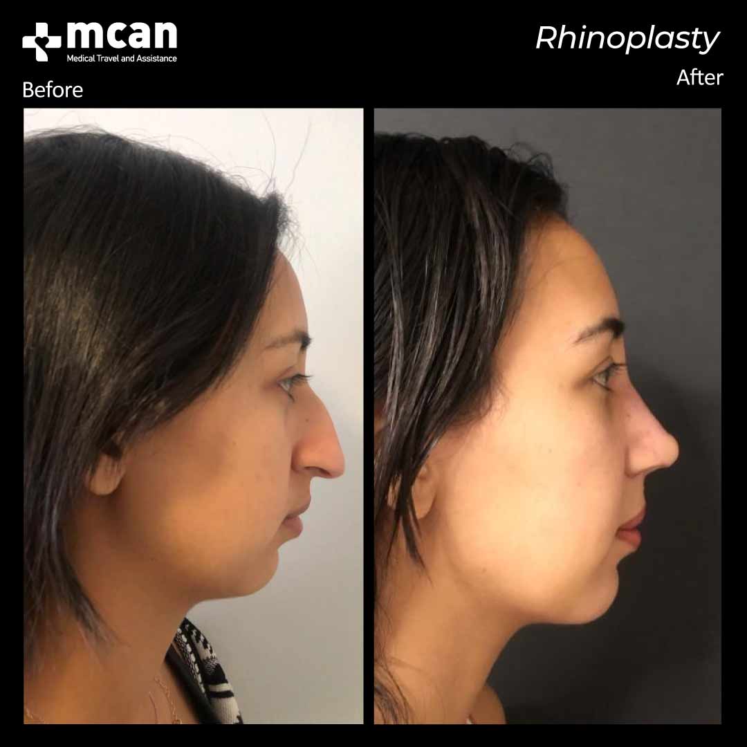 rhinoplasty before after 2203020 2