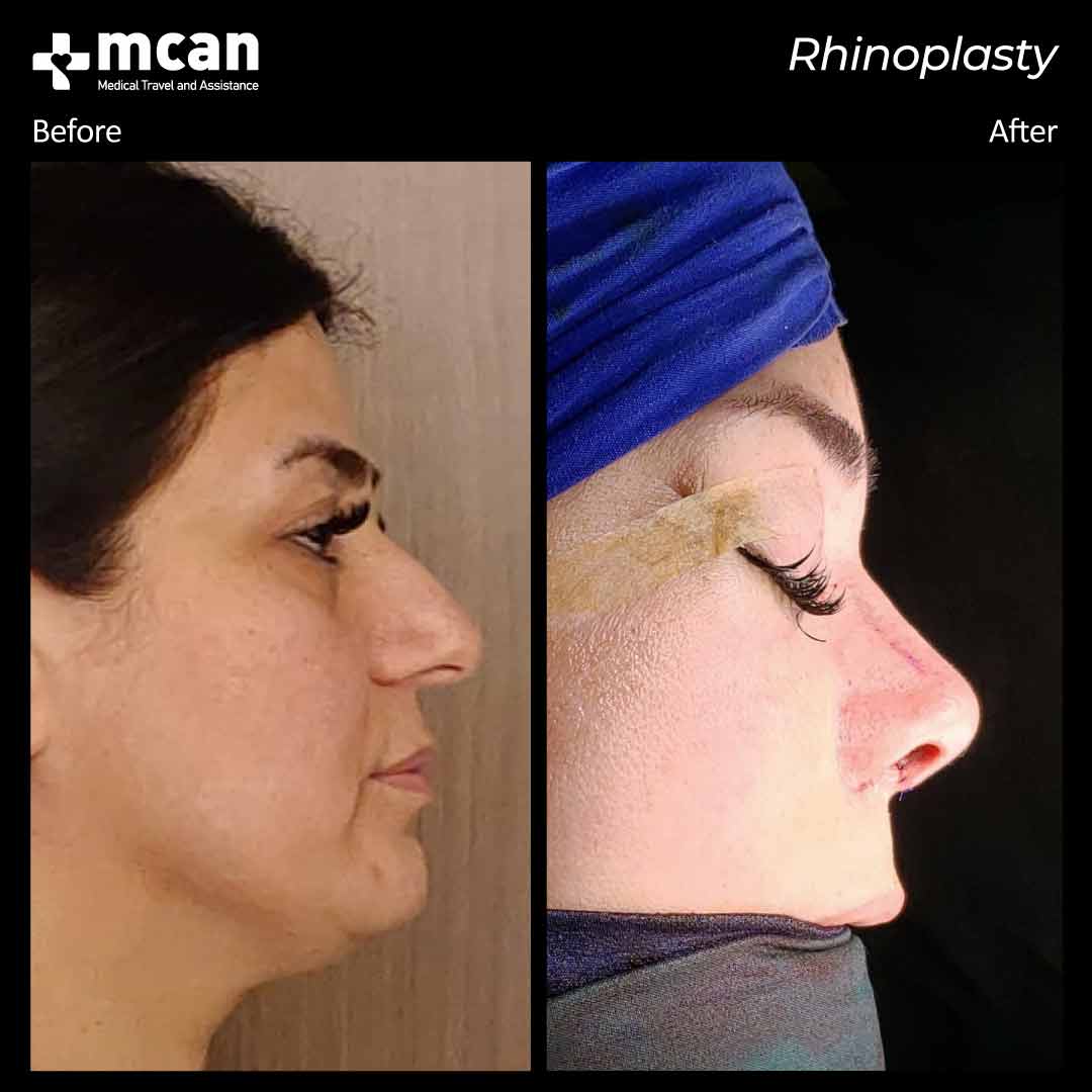 rhinoplasty before after 220305 2