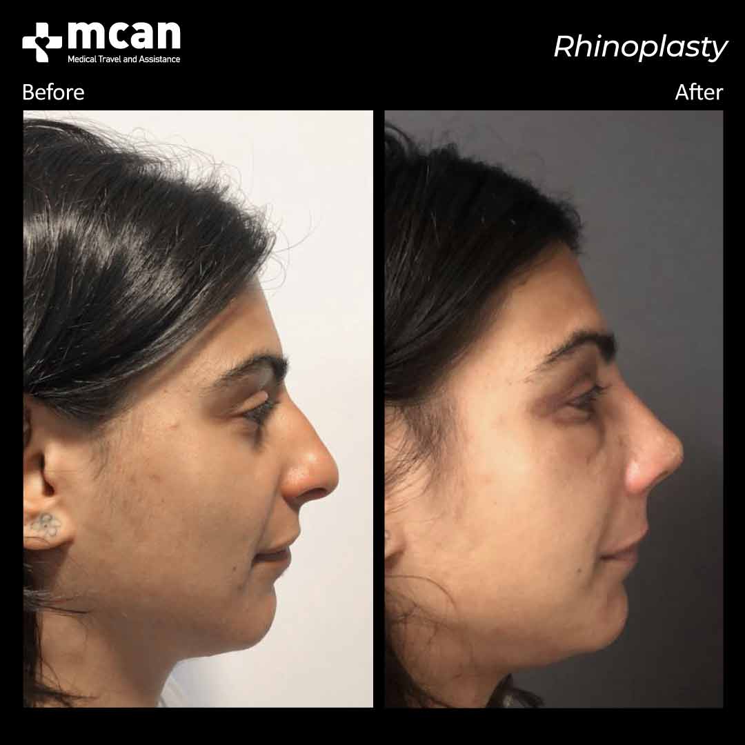 rhinoplasty before after 220308 2
