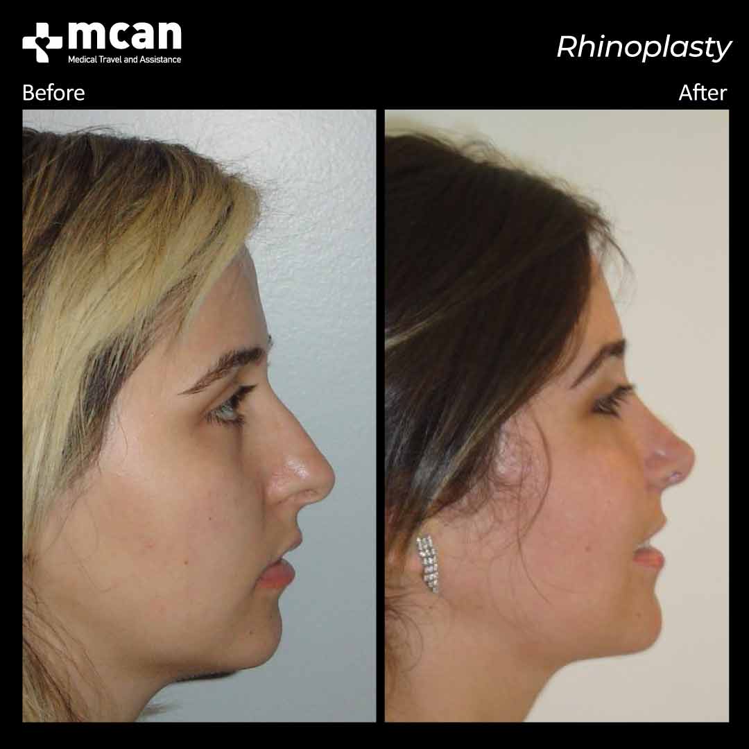 rhinoplasty before after 220309 2