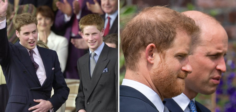 All About Prince Harry Hair Transplant 8 royal family hair loss Prince harry bald, Prince William bald