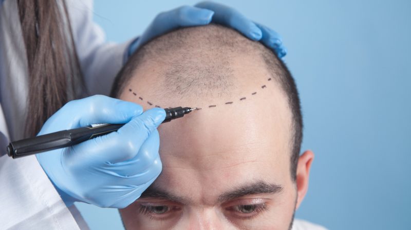 Doctor establishes the recipient area where grafts will be implanted