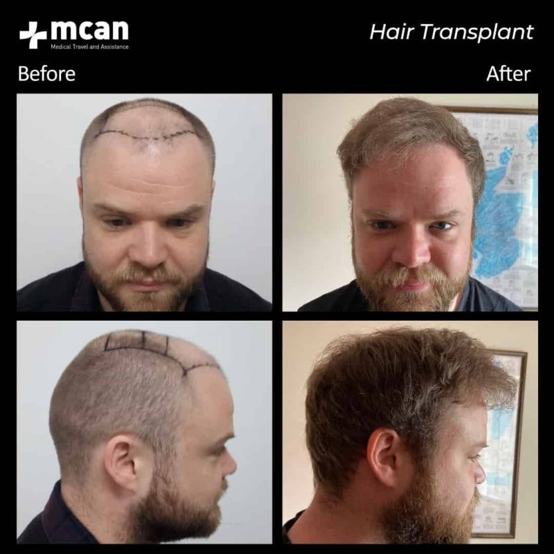 5000 grafts hair transplant before and after
