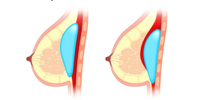 Brustimplantate über und unter den Muskeln