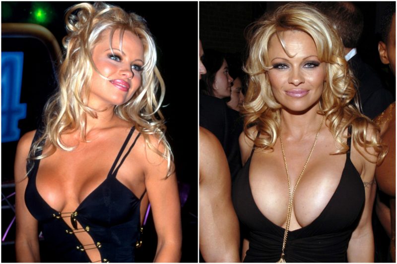 Brustimplantate von Pamela Anderson