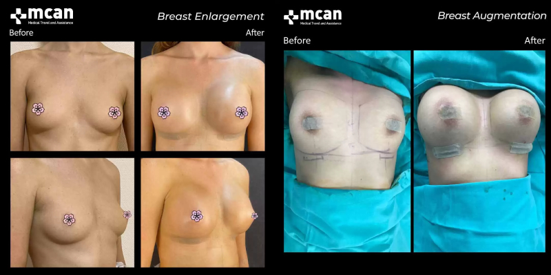 Brustimplantate vorher und nachher mit mcan health