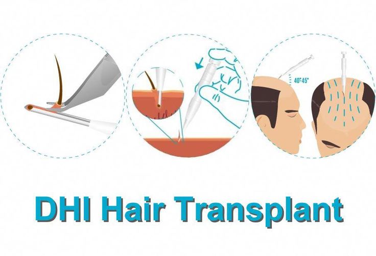 DHI hair transplant procedure in 3 steps cartoon image