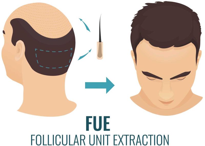FUE Follicular unit extraction 