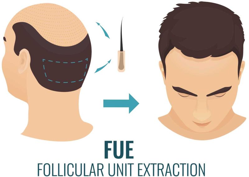 fue grafts FUE Follicular unit extraction