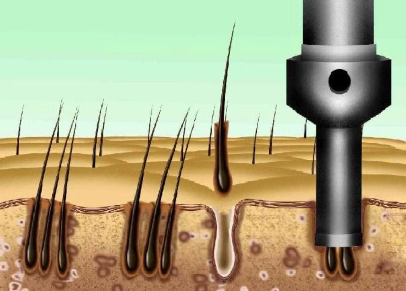 Scalp landscape with graft extraction cartoon with DHI method