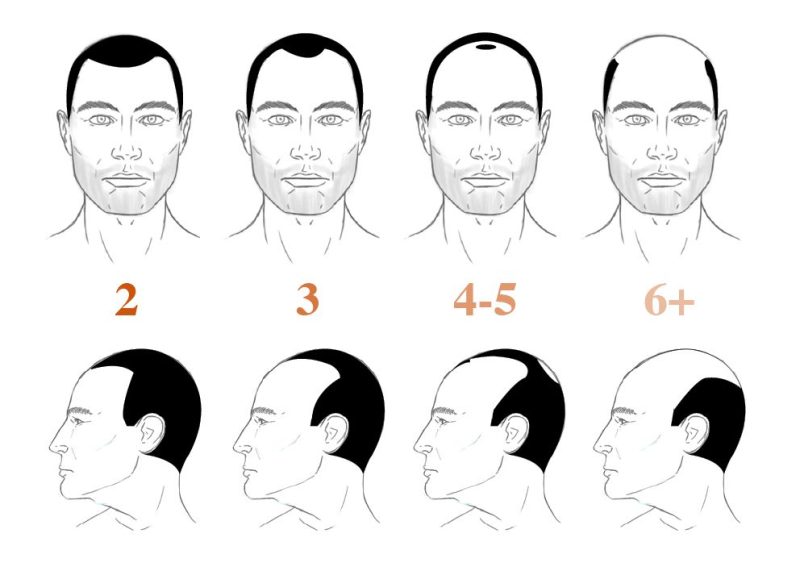 Norwood Hamilton hair loss stages from 2 to 6+ in cartoon drawings of a male face from the side and from the front