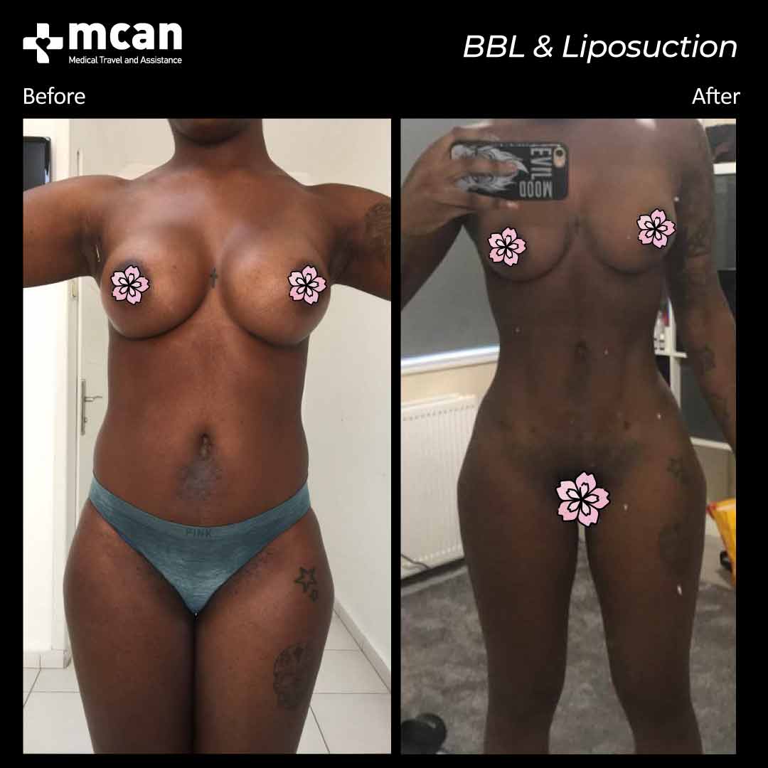 bbl liposuction before after 12042101