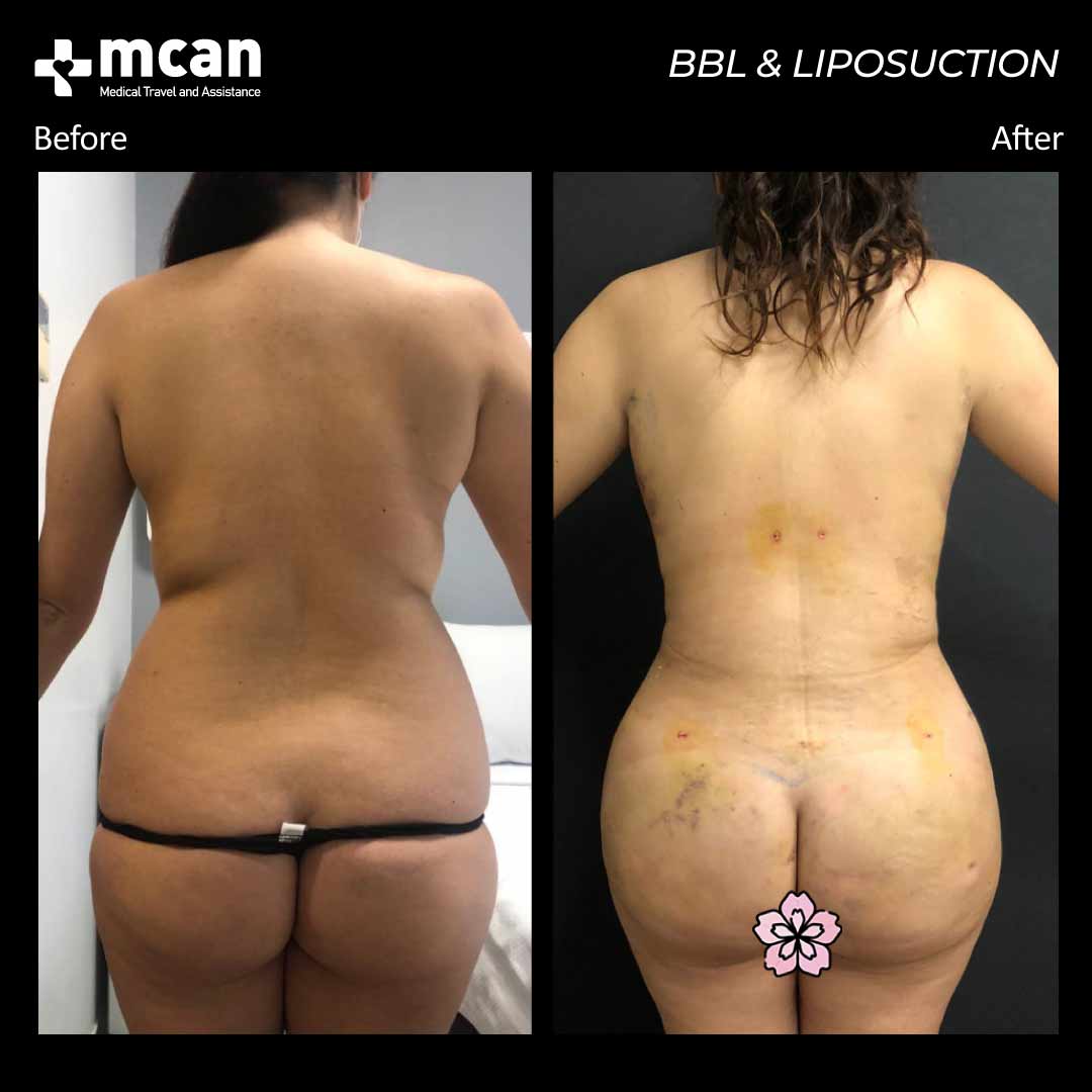 bbl liposuction in turkey before after 30042101