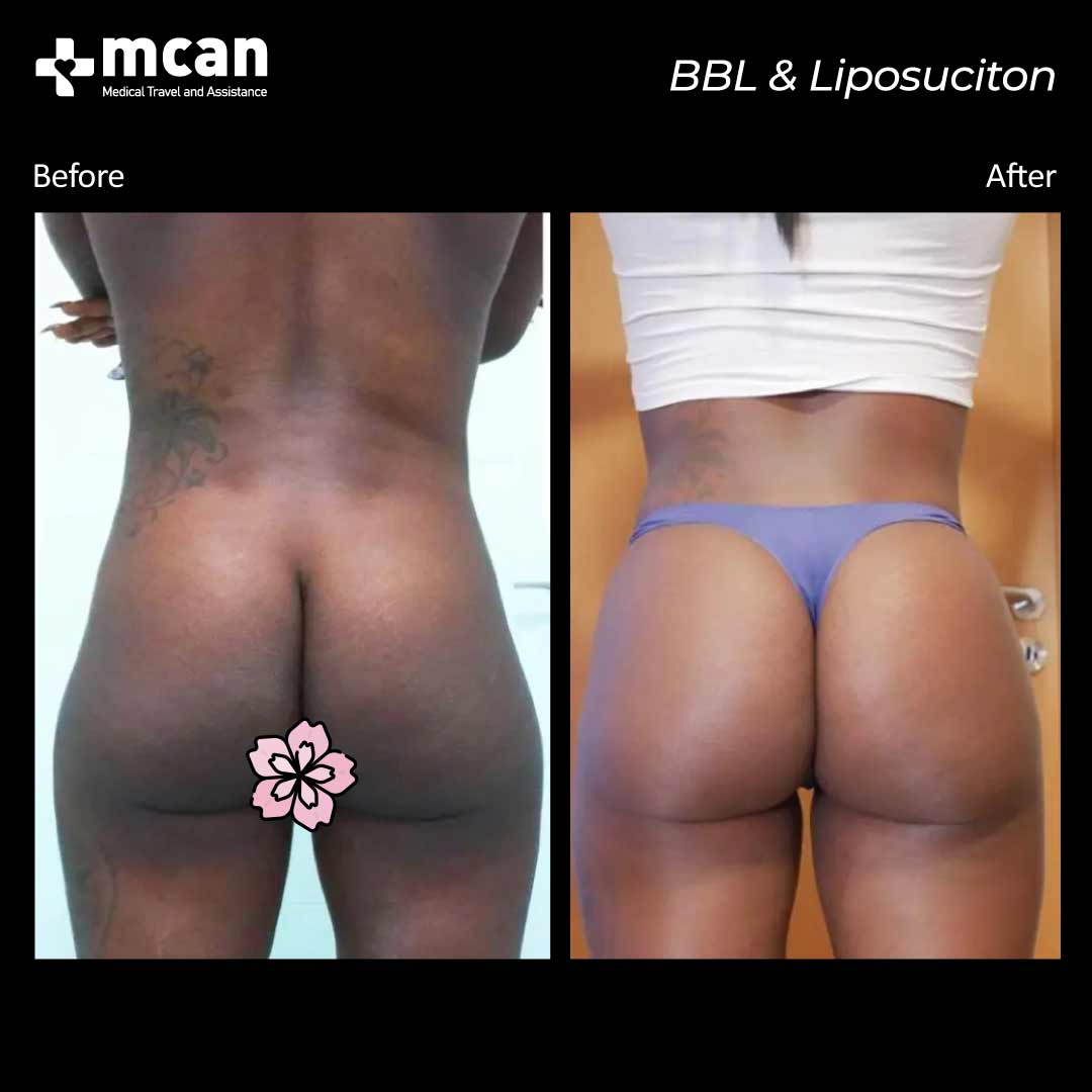 bbl liposuction turkey before after 120421010