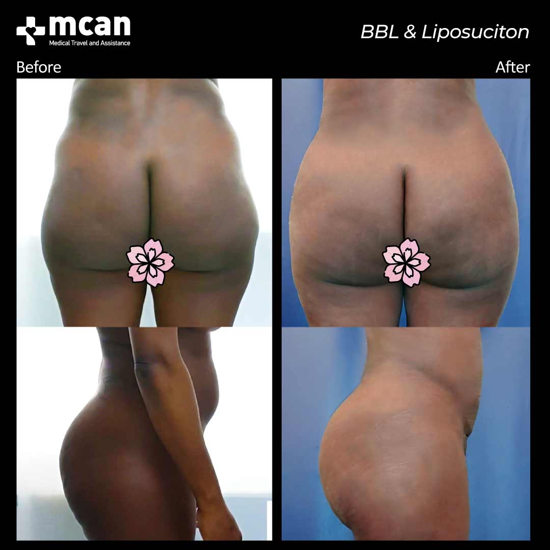 bbl liposuction turkey before after 12042103