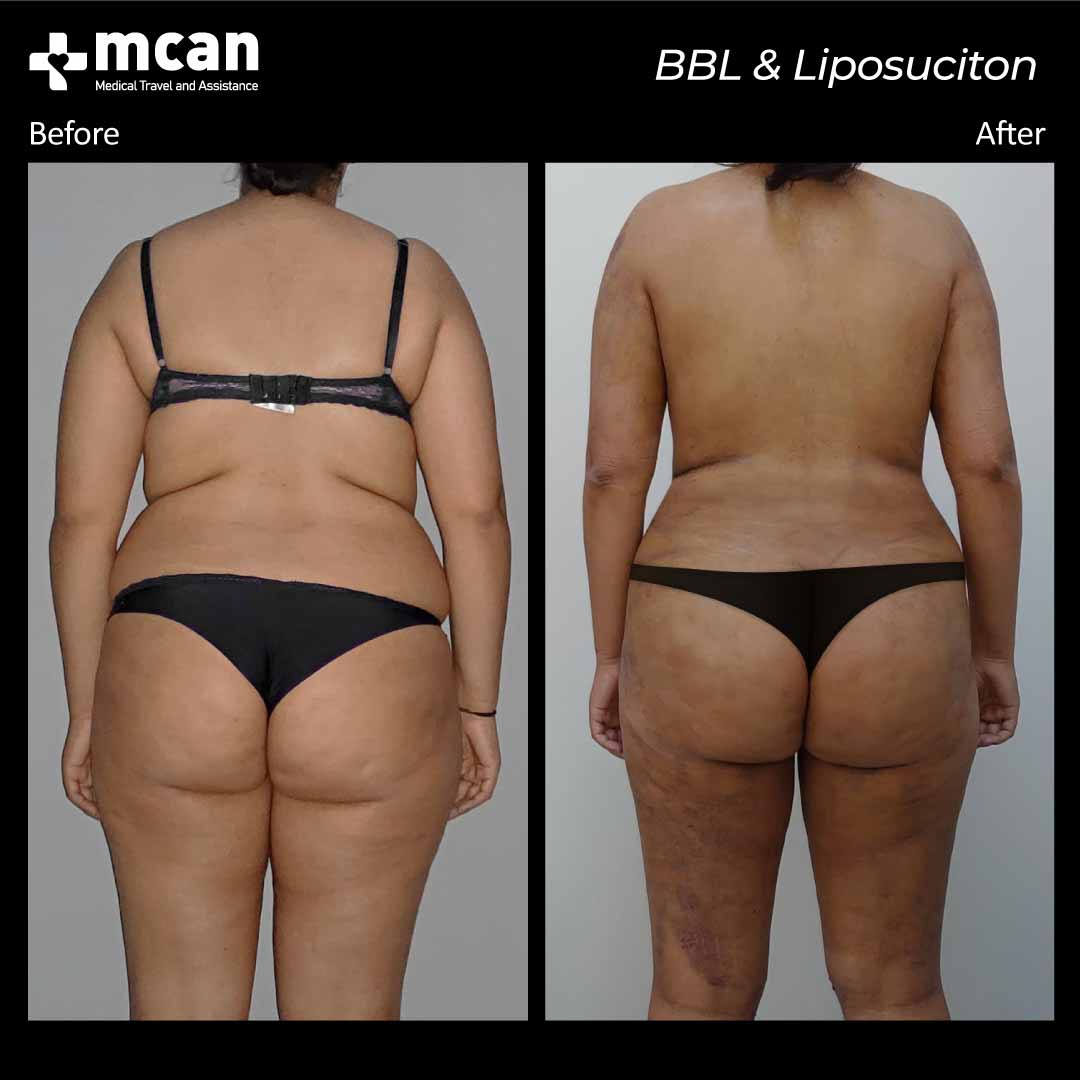 bbl liposuction turkey before after 12042104