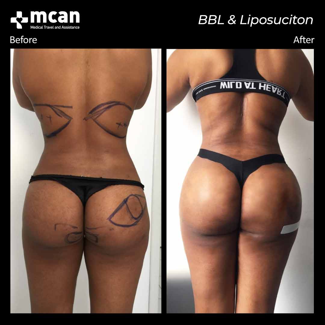 bbl liposuction turkey before after 12042105