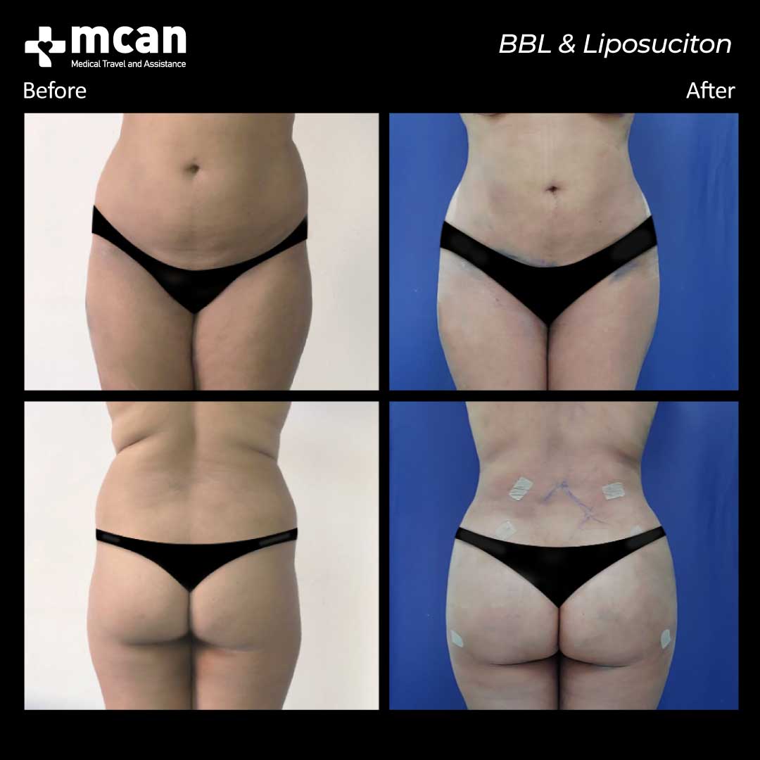 bbl liposuction turkey before after 12042107