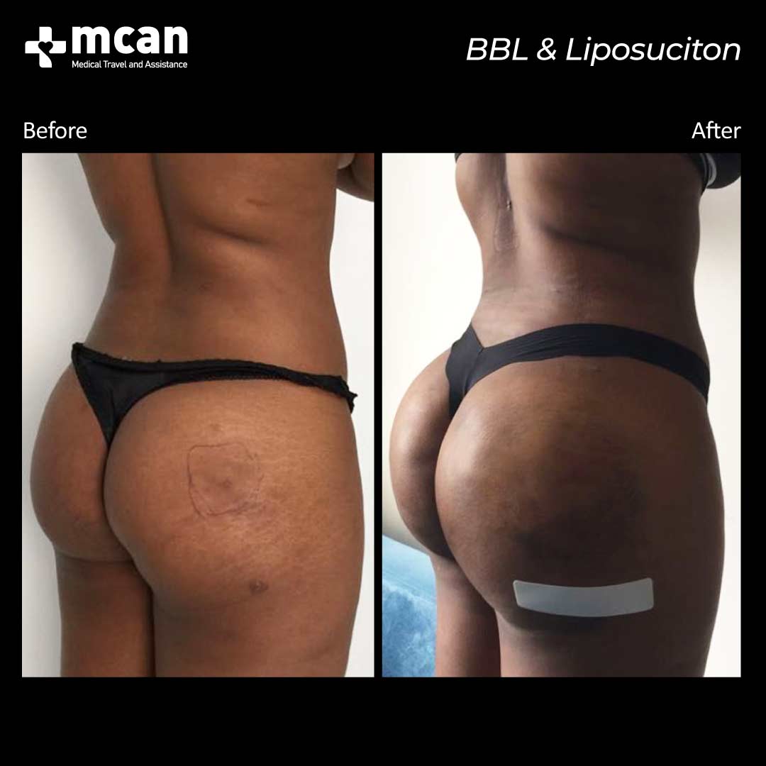 bbl liposuction turkey before after 12042108