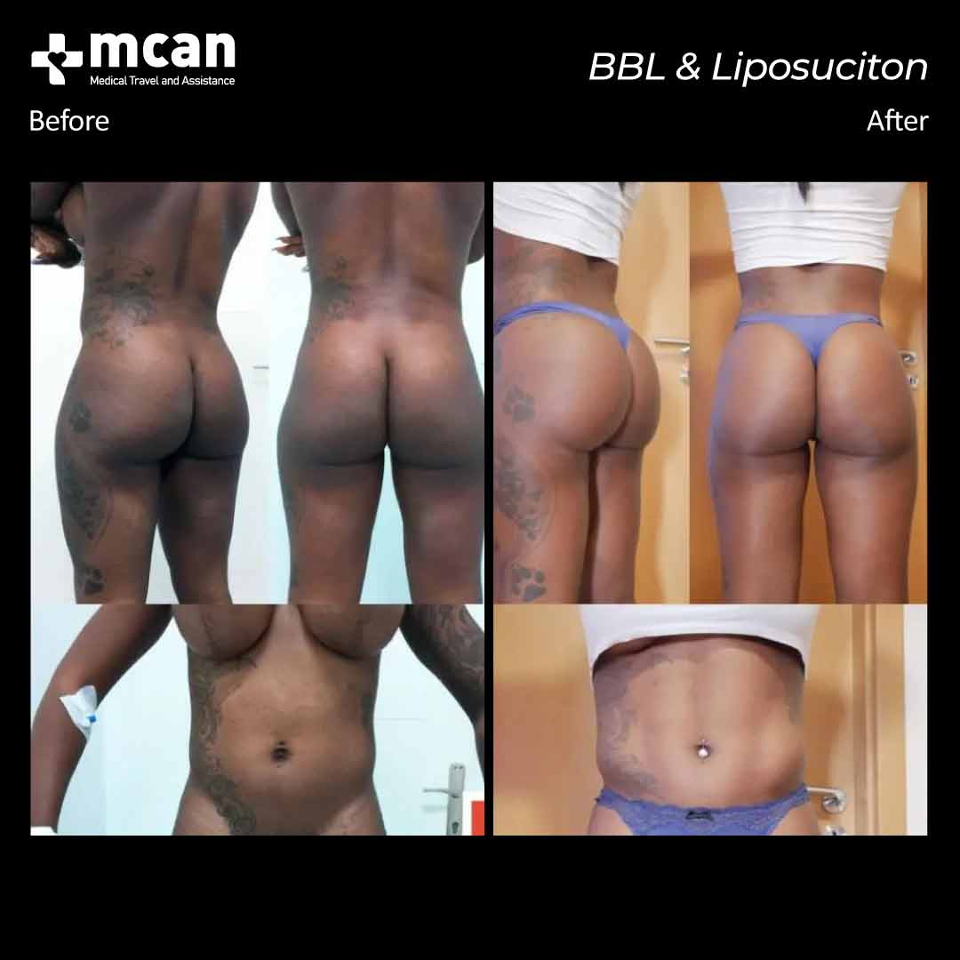 bbl liposuction turkey before after 12042109