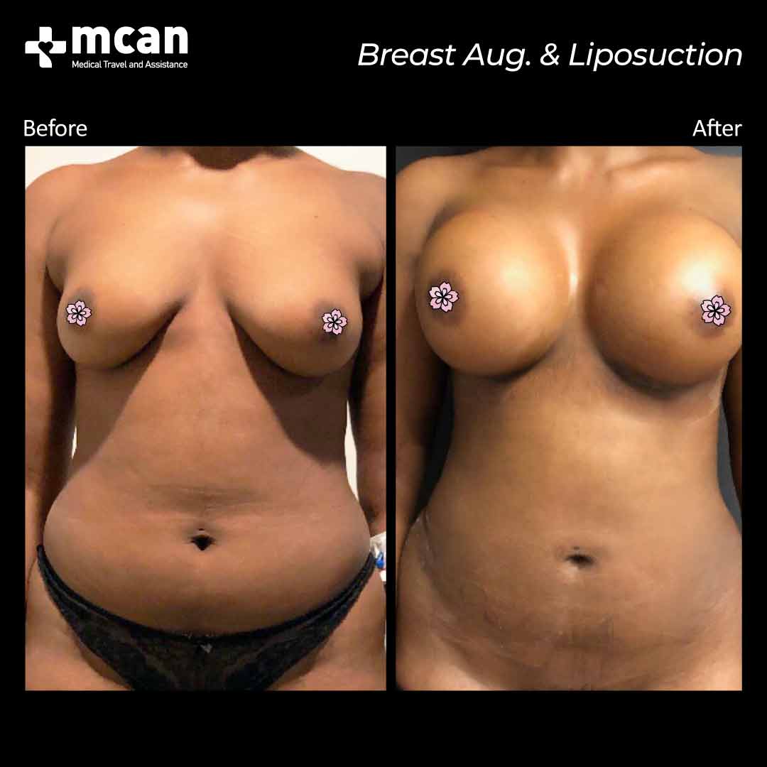 breast augmentation liposuction turkey before after 12042101